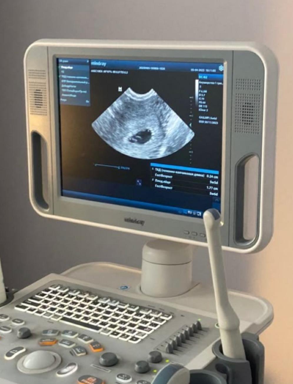 УЗИ диагностика беременности